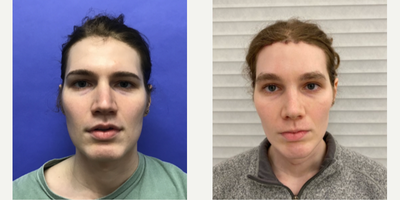 Patient treated with Rhinoplasty, Septoplasty - Septorhinoplasty with Cartilage Grafts and Weirs - 25 to 34 year-old female patient is 1 month post-op from Facial Feminization surgery. Her procedures included: Forehead Lift, Hairline Lowering, Supra Orbital Bone Reduction and Contouring, Septorhinoplasty with Cartilage Grafts and Weirs, Chin Reduction and Contour, Soft Tissue to Nasolabial Folds, Intranasal Lip Lift, Thyroid Cartilage Shave, and Voice Feminization.