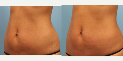 35-44 year old woman treated with Lux 1540 - This client came to our office concerned about skin laxity and stretchmarks on her abdomen and scarring above her umbilicus (navel).
A series of Non-Ablative Laser Resurfacing (1540) treatments was recommended to improve stretchmarks & scar appearance, combined with Venus Legacy to help tighten and firm the loose skin.