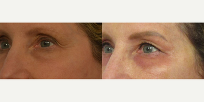 Woman treated with Profound RF - Patient is only 2 weeks post-procedure after receiving Profound and Fraxel Repair to her eyes.