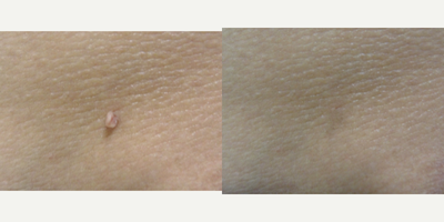 18-24 year old woman treated with Cyst Removal - 23 year old female before and 6 months after excision of skin tag of her left neck. Patient is very happy with the results and there is no evidence of scarring.
