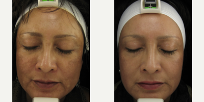 45-54 year old woman treated with Clear and Brilliant - Clear and brilliant for melasma
