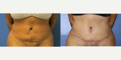 18-24 year old woman treated with Tummy Tuck Revision - 18-24 year old woman treated with Tummy Tuck Revision