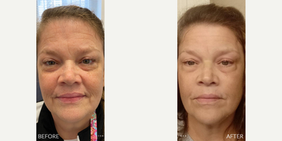 55-64 year old woman treated with PlasmaMD - Reduce Crepey Skin on Eyelids with Plasma PenMy patient wanted to reduce crepey skin around her eyes so I used Plasma Pen which is a focused radio-frequency plasma energy device used to tighten and resurface the skin. The concentrated energy goes directly onto the skin and creates little channels in the skin that will scab and peel over the next few days and cause the skin to tighten. This was the right choice for my female patient here that has crepey skin around her eyes. Treatment areas:Plasma Pen can be used to tighten areas around the mouth and the eyes such as the crows feet and can be extended to the brow like our patient today. It can also be done on the neck, chest, knees, elbows, and anywhere else with loose skin
