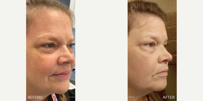 55-64 year old woman treated with PlasmaMD - Reduce Crepey Skin on Eyelids with Plasma PenMy patient wanted to reduce crepey skin around her eyes so I used Plasma Pen which is a focused radio-frequency plasma energy device used to tighten and resurface the skin. The concentrated energy goes directly onto the skin and creates little channels in the skin that will scab and peel over the next few days and cause the skin to tighten. This was the right choice for my female patient here that has crepey skin around her eyes. Treatment areas:Plasma Pen can be used to tighten areas around the mouth and the eyes such as the crows feet and can be extended to the brow like our patient today. It can also be done on the neck, chest, knees, elbows, and anywhere else with loose skin.