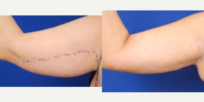 45-54 year old woman treated with Tickle Lipo - Tickle Lipo