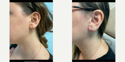 25-34 year old woman treated with Earlobe Repair - 28 year old female with earlobe repair