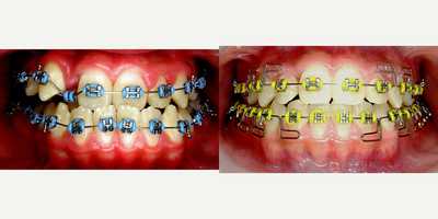 17 or under year old treated with Braces - Patient had treatment for the correction of crossbite and crowding. Correction was obtained in less than 6 months.