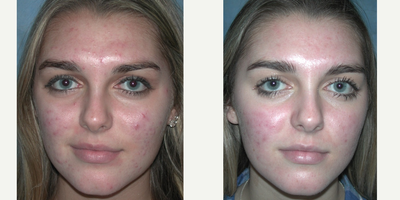 17 or under year old woman treated with Acne Treatment - ZO Acne System plus PCA Peel