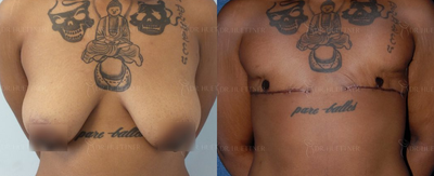 Patient treated with FTM Chest Masculinization Surgery - Patient treated with FTM Chest Masculinization Surgery