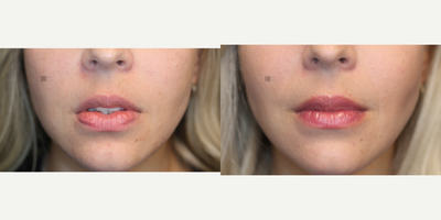 Silicone Lip Filler Revision - Silicone lip filler revision. Prior silicone lip filler distortion corrected with scarless lip surgery.
