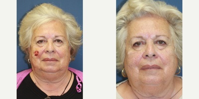Mohs Surgery Reconstruction - Mohs Surgery Reconstruction