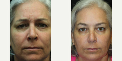 50 year old woman treated with Botox for Migraines - 50 year old woman seeking to address early signs of aging consulted with Dr. Kris Reddy FACS. Dr. Reddy performed Botox about 40 units and dermal fillers (1 syringe of Juvederm Ultra in the nasolabial folds and perioral lines and 1 syringe of Voluma for the lower face and chin area). The dermal fillers softened the nasolabial folds, improved the perioral area, better defined the lip line, and better contoured the chin and lower face. Patient wanted to have Botox performed for cosmetic reasons and to treat migraine headaches.