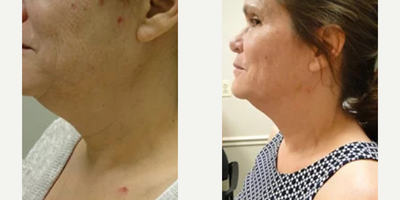 Woman treated with Infini RF - Woman treated with Infini RF