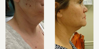 Woman treated with Infini RF - Woman treated with Infini RF