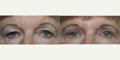 55-64 year old woman treated with Eyelid Surgery - 60 year old female treated with Upper and Lower Lid Blepharoplasty (eyelid lift).