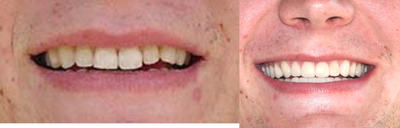 Lumineers - Before and after Lumineers.