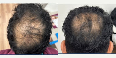 25-34 year old man treated with PRP for Hair Loss - PRP hair restoration and Fotona laser  Hairlase/ HaiRestart are two procedures at our clinic to fight hair loss. PRP injection is a natural way to inject your own growth factors to your scalp and stimulate new hair growth while decreasing shedding. Fotona laser helps to grow new hair and decrease hair loss as well. We have a very high success rate for both procedures at our clinics. This after picture is after only 3 sessions.