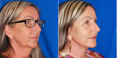 55-64 year old woman treated with Deep Plane Facelift - This patient presented with advanced signs of facial aging. There is extensive skin laxity in the neck, significant jowls, and sagging cheeks. Facial rejuvenation procedure included lower facelift with a neck lift Significant facial rejuvenation was achieved by tightening up excessive skin of the neck, smoothing out prominent jowls and restoring a pleasing cheek contour.