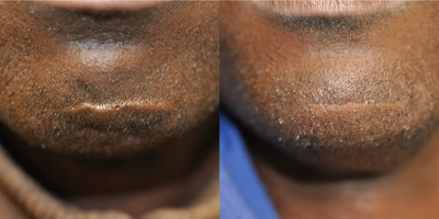 40 year old male treated with Scar Excision and Resurfx Laser - 40 year old male treated with Scar Excision and Resurfx Laser.