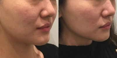 25-34 year old woman treated with Thermage FLX - age 25-34 years old woman treated with Thermage FLX on lower face