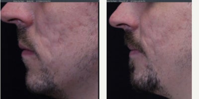 Man treated with UltraClear Laser - Man treated with UltraClear Laser