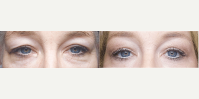 Woman treated with Subnovii Plasma Pen - Woman treated with Subnovii Plasma Pen
