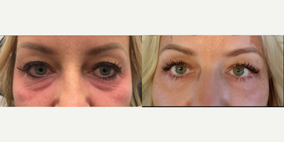 Woman treated with Subnovii Plasma Pen - Woman treated with Subnovii Plasma Pen