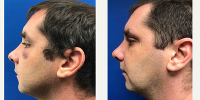35-44 year old man treated with Cyst Removal - Excision in combination with Venus Viva laser treatment to eliminate this man's cyst on his face.