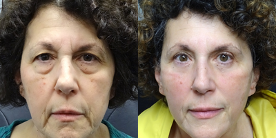 55-64 year old woman treated with Eyelid Surgery - Treated with Blepharoplasty Both Upper Lids and Excision Herniated Orbital Fat Both Lower Lids with CO2 Laser.