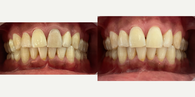 25-34 year old man treated with Internal Tooth Bleaching - Male patient, internal whitening was performed on left frontal tooth, 3 sessions were enough to achieve these result