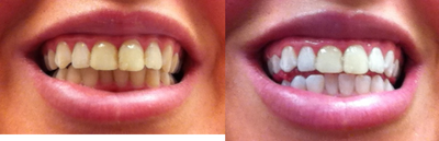 Zoom Whitening - 
	The patient had stains on her teeth and wanted a whiter teeth and smile. The session lasted just under an hour. After a quick cleaning and polishing, the teeth were covered with a gel to prevent sensitivity. This patient reported sensitivity in her last session which persisted for a couple of hours.
