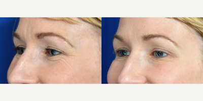 35-44 year old New Orleans woman treated with Botox - New Orleans woman treated with Botox to her crows feet by Dr. Sean Weiss in Metairie, Louisiana.