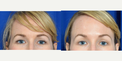 35-44 year old New Orleans woman treated with Botox - New Orleans woman treated with Botox to the Glabella by Dr. Sean Weiss in Metairie, Louisiana.