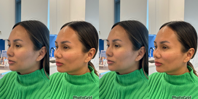 35-44 year old woman treated with Dermal Fillers, Cheek Augmentation, Lip Fillers - Immediately after cheek, chin, lip, pyriform, and pre jowl sulcus filler by RN Cindy