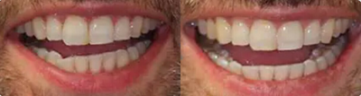 Man treated with Invisalign - Patient complained of relapse from prior orthodontics that he had when younger. Invisalign was used in conjunction with Dr. Steven Davidowitzs Accelerated Propel technique and was completed in less than 6 months.