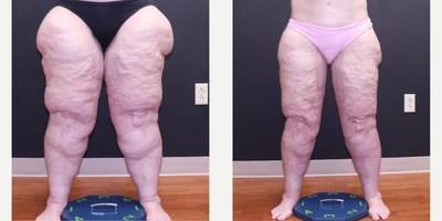 55-64 year old woman treated with Lipedema Surgery, Laser Liposuction - Lipedema patient who had a total of 3 liposuction surgeries. 1) inner and anterior thighs, 2) lateral thighs, hips and buttocks and 3) calves and ankles.