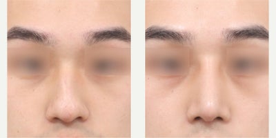 25-34 year old man treated with Asian Rhinoplasty, Rhinoplasty - He had rhinoplasty (hump smoothing, bulbous tip correction, donated rib cartilage)