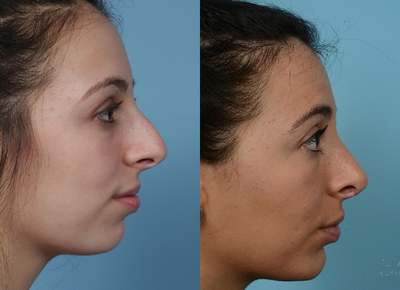 Patient treated with Rhinoplasty - Patient treated with Rhinoplasty