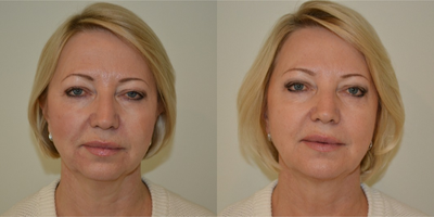 55-64 year old woman treated with ThermiTight - Thermi Tight  treatment of the lower face and neck 2.5 months ago.&nbsp;