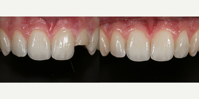 25-34 year old man treated with Tooth Repair - 25-34 year old man treated with Tooth Repair after Trauma to front tooth.