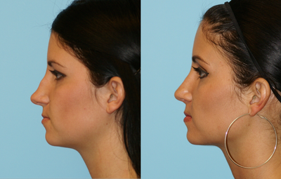 Nose Reshaping - 
	This patient wanted to treat the hump and dips in her nose which would show up in photographs.The doctor performed an Endonasal Rhinoplasty (no external sutures required, to straighten her nose and make it more elegantly balanced to her face.
