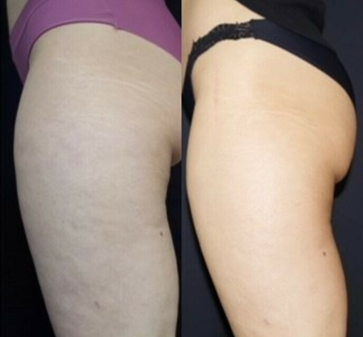 Woman treated with Cryoskin - Woman treated with Cryoskin