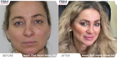 35-44 year old woman treated with Rhinoplasty, Facial Fat Transfer - 35-44 year old woman treated with Rhinoplasty, Facial Fat Transfer