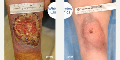 65-74 year old woman treated with EVLT - Severe leg ulcer