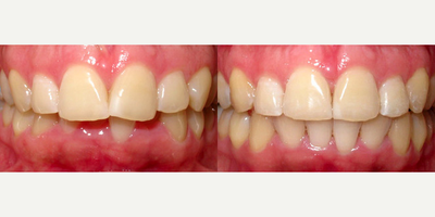 Invisalign - Invisalign
