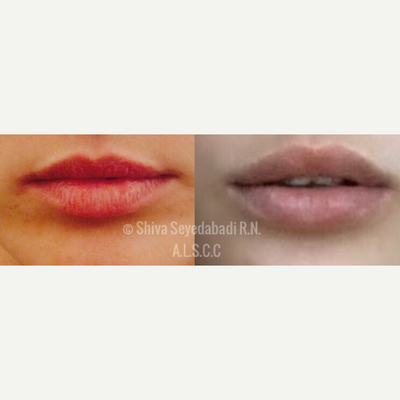 Dermal Fillers before and after photo