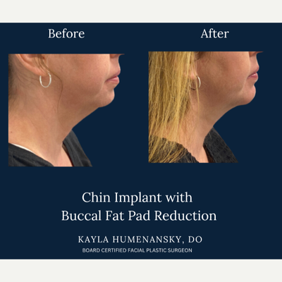 Chin Implant before and after photo