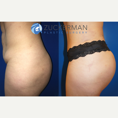Brazilian Butt Lift before and after photo