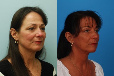 Facelift before and after photo