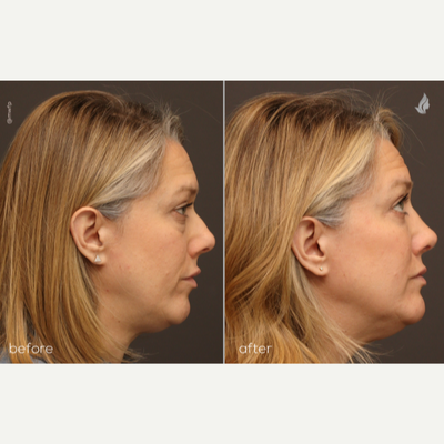 Eyelid Surgery before and after photo
